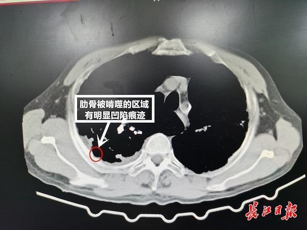 手术|肋骨痛了两年，原来是细菌抱团在肺上“安家”