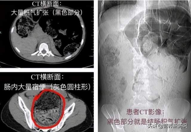 年年体检“正常”依然被诊断癌症晚期，最强保障还是靠饮食预防