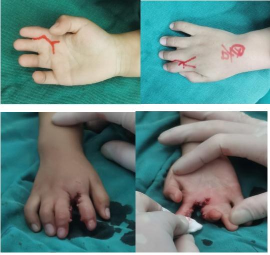 儿科|摆“剪刀手”不再是梦，儿童医院援滇医疗队完成当地首例罕见病患儿并指分离手术