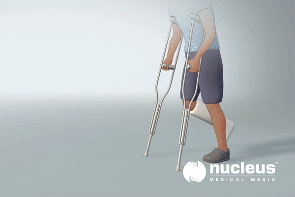 辟谣I膝关节置换手术别做，会更痛苦？医生：重视术后康复效果佳