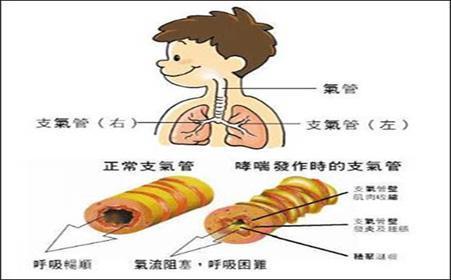 你的育儿经▲小儿哮喘的中西医结合治疗