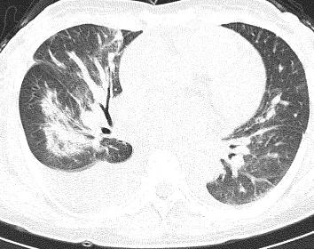 「典型」的肺水肿，为何用抗生素狂轰滥炸？