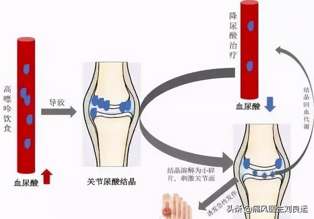 解锁降尿酸治疗后痛风发作不止的原因：伪降酸、溶晶痛和不良生活