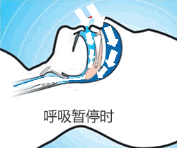呼吸|打呼噜是睡的香吗？一男子睡着呼噜作响，竟“断气”432次