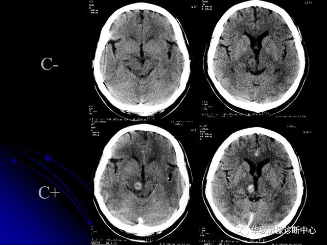 「影像复习」脑干区常见病变影像表现