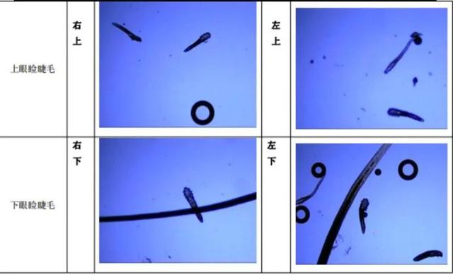 也不管用,到医院一查,竟然在睫毛里发现了17条螨虫,还引发了干眼症