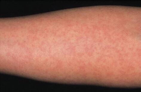 一种被人们忽视的儿童传染性皮肤病——风疹