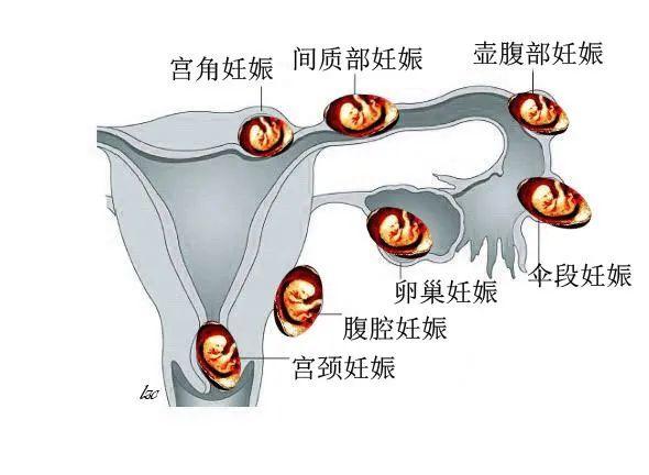 子宫|凶险！杭州一姑娘临产，一胎在子宫里，另一胎竟在……