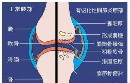 骨性关节炎|科普：膝关节骨性关节炎的诊断标准及分级，膝盖不好的人需要看看