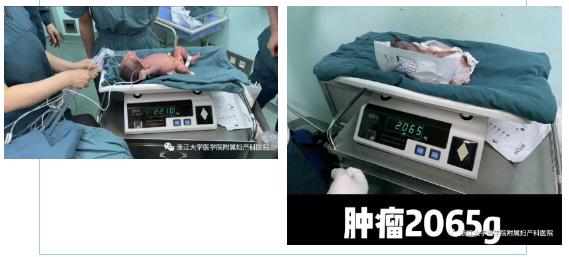 你的育儿经|生死时速！宝宝身上拖着“巨型炸弹”医生和胎盘“抢时间”