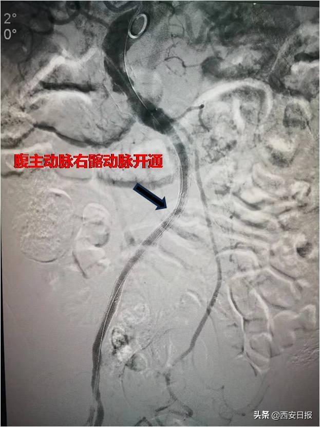 患者|妙手打通主髂动脉闭塞 96岁“爷坚强”挺过来了