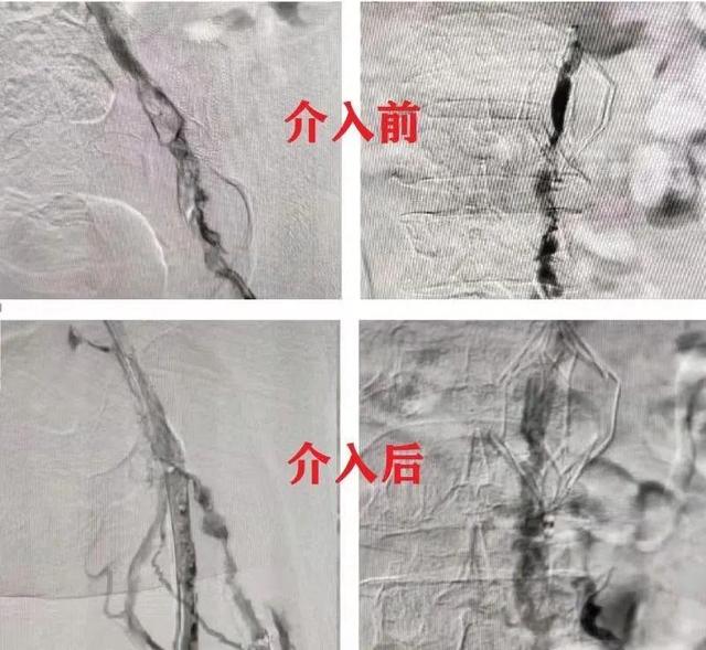 我院外科成功实施一例右下肢静脉血栓取栓溶栓术