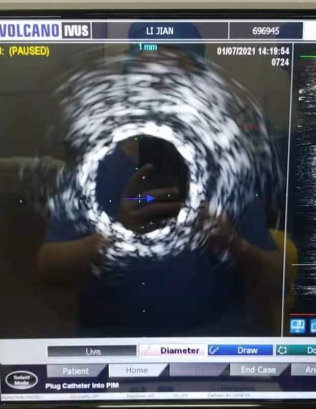 心脏支架降价后第一批受益者