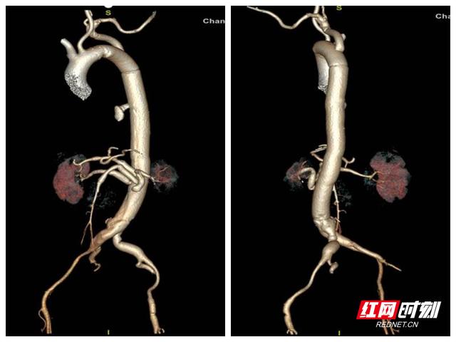 19小时手术完成胸部“拆弹”常德一医实施湘西北首例全胸腹主动脉置换