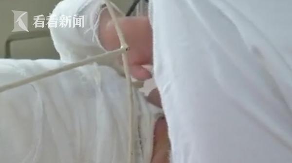 光明网▲1岁女童掉入70℃热水锅烧伤严重 发现时已休克