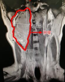 肿瘤|字少情长 这封古诗体感谢信背后是一台长达15小时的接力手术