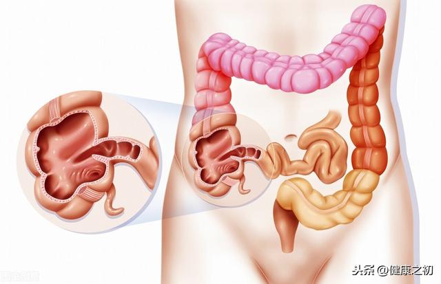 长期腹泻或便秘，再加以下任一症状，警惕大肠癌，6类人群要注意