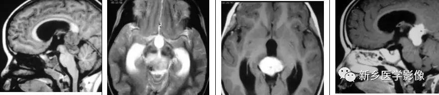 12种松果体区肿瘤的影像表现