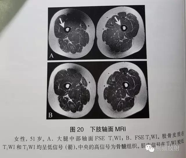 「MRI入门」如何分辨T1WI与T2WI？