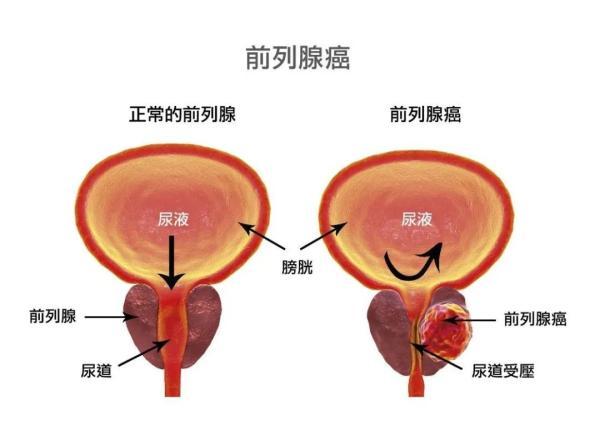 前列腺|浙江一男子腰痛半月，一查竟是癌症晚期！这症状很多人忽视