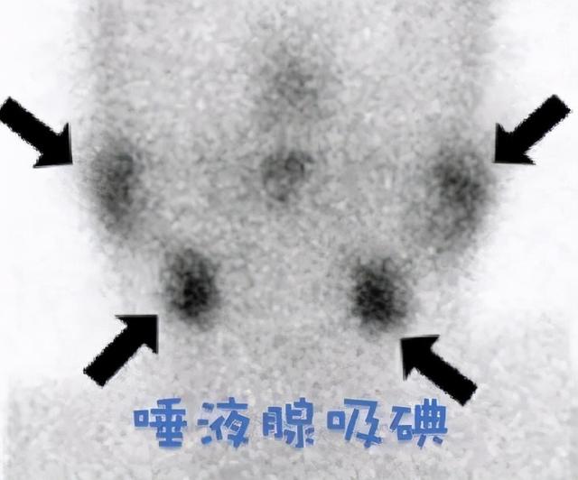 后甲状腺癌时代让人恐惧的第二肿瘤