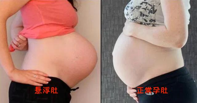 「超级宝妈」“悬浮肚”十产九剖，上怀下怀说法多…对照下你的孕肚是哪种？