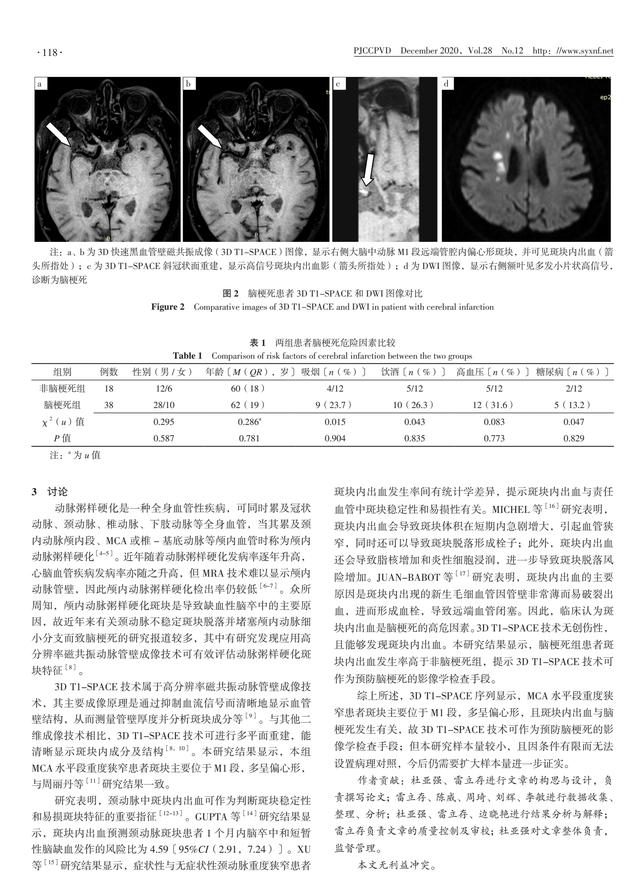 大脑中动脉水平段重度狭窄患者斑块特征及其与脑梗死的相关性分析