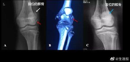 髌骨|14岁男孩打篮球“太猛”，骨折了……