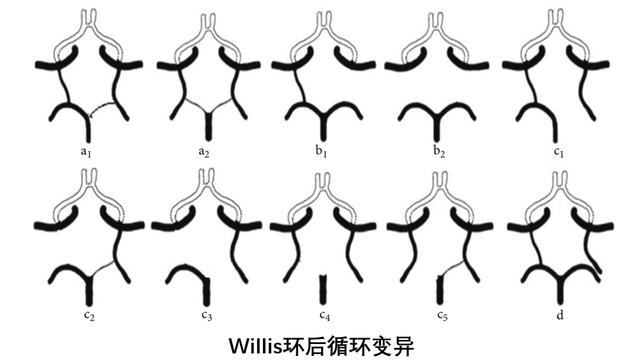 脑内的Willis环，你知道吗？