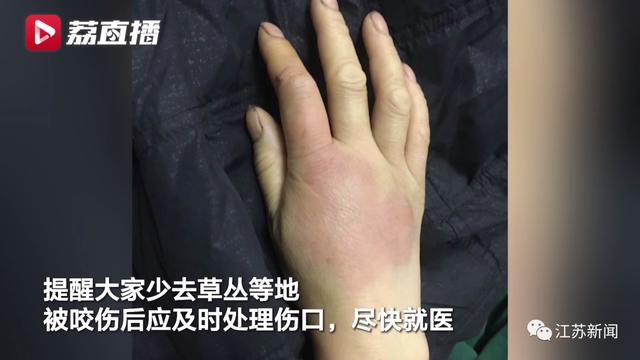 咬伤|被它咬了一口，女子窒息身亡！医生：第一时间应这样做