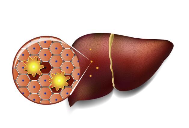 得了脂肪肝，不妨多吃这4种食物，喝2种饮品，助你甩掉脂肪肝