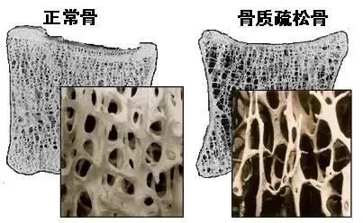 中老年人|中老年人如何预防骨质疏松症