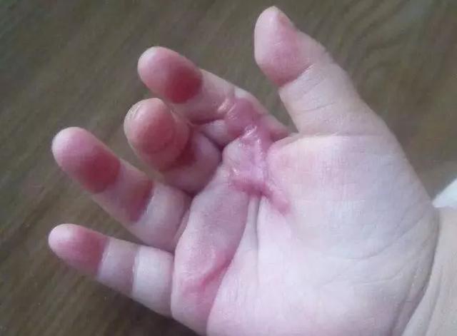 超级宝妈|宝宝摔伤后怎么做才能不留疤？这些护理方法每位家长都要Get到