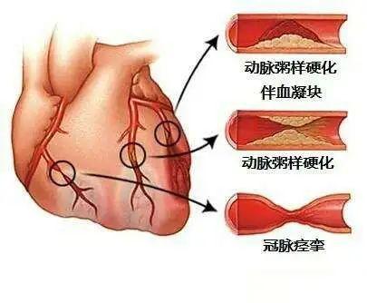 吸烟的人更容易得冠心病吗？