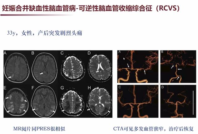 「超级宝妈」张馨：3类需要注意的妊娠合并神经系统疾病