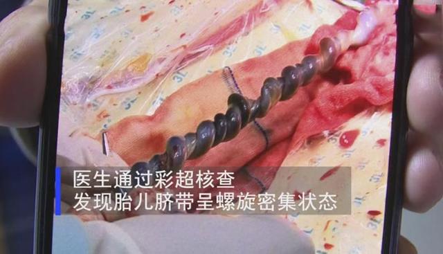 超级宝妈@胎儿调皮把脐带玩成“麻花状”，别急着夸娃聪明，背后暗藏凶险