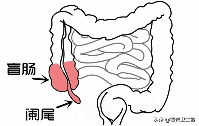 阑尾炎|福州一男孩喝完冰牛奶后腹痛发热，一查是阑尾炎！医生：经常被家长误诊为肠胃炎