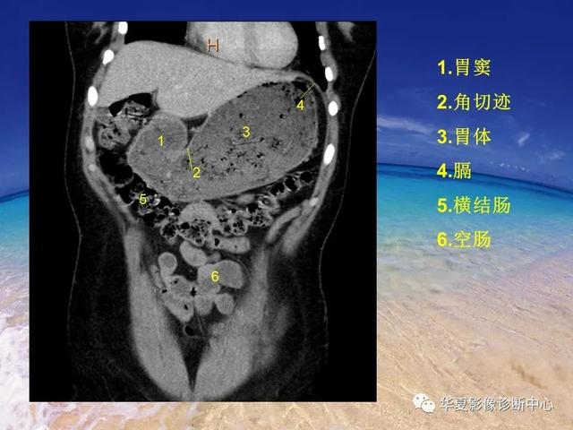 消化道穿孔的CT诊断