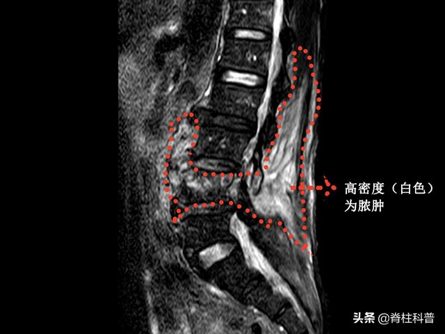 入院成为重点保护对象：68岁阿叔脊柱化脓了还合并有电解质紊乱