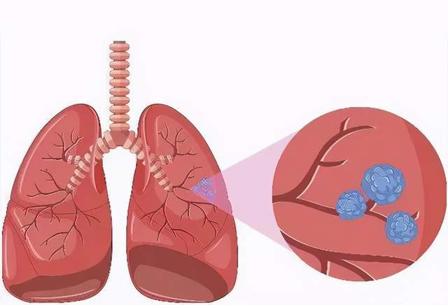 肺部有结节别急,不妨常吃2种水果,或可有助于肺部健康