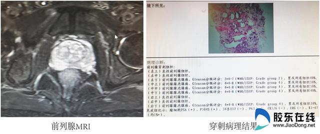 主任|前列腺癌诊疗一体化 滨医烟台附院“医”步到位解病痛