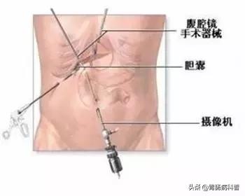 病变|体检发现胆囊息肉，到底该不该切除？