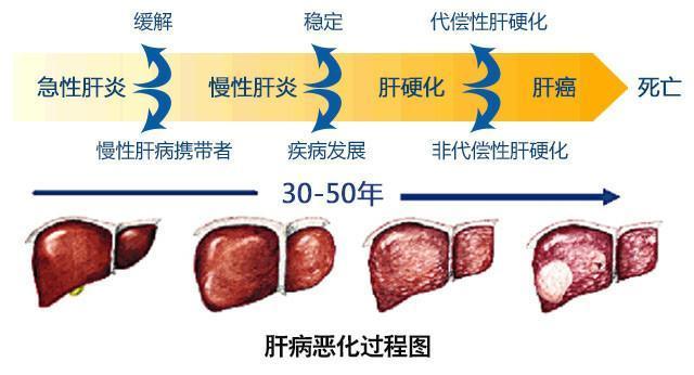 肝脏|肝纤维化如何治疗？能否逆转？抗肝纤维化能做些什么？医生告诉你