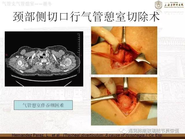 遇到气管、支气管憩室莫惊慌