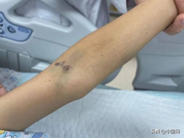 小宇|广西一9岁男孩被毒蛇咬伤，害怕被责骂选择隐瞒！病情一度恶化
