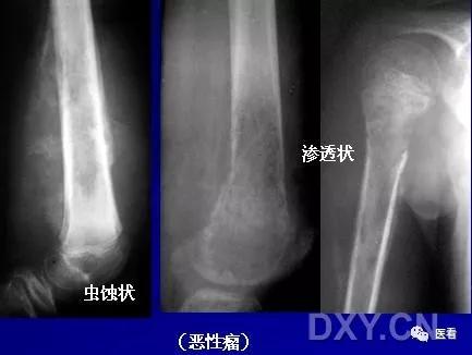 9个骨肿瘤医学影像诊断分析基本要点，如此精彩怎能错过