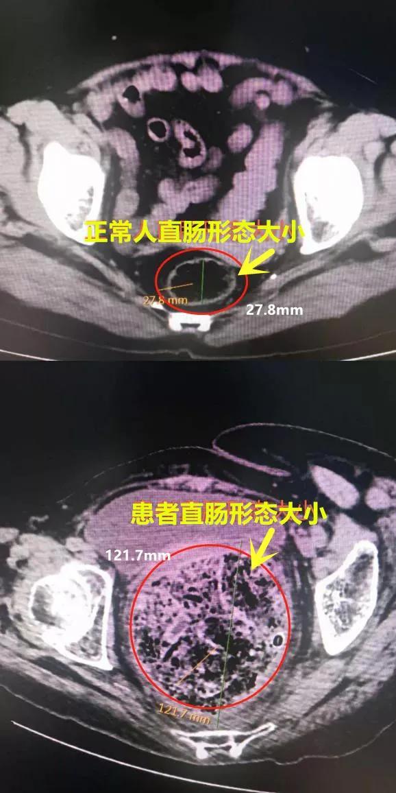 便秘30年，肚里竟藏十多斤大便，肠道是别人4倍大