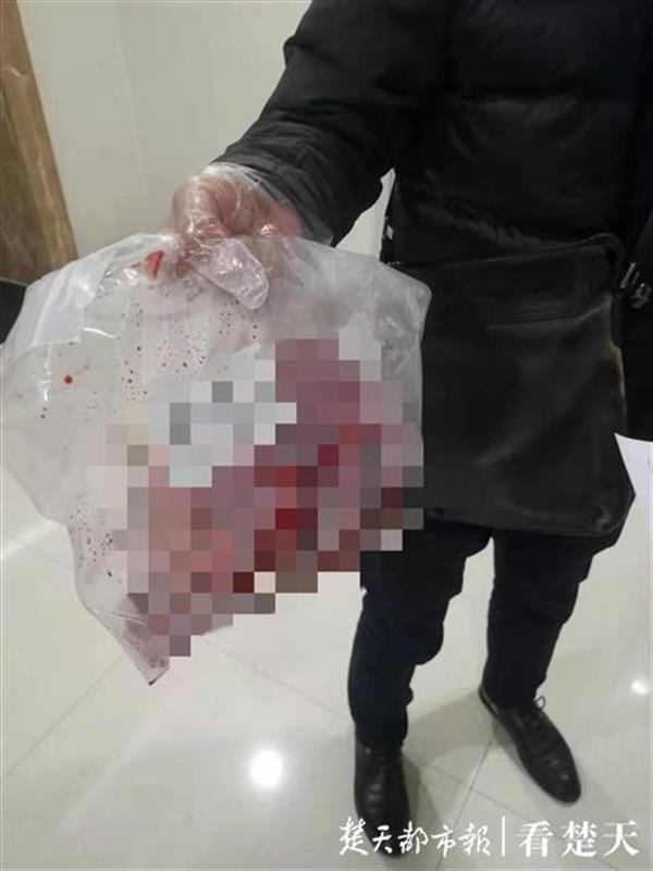 患者体内长出巨大肿瘤，医生12小时手术成功取出