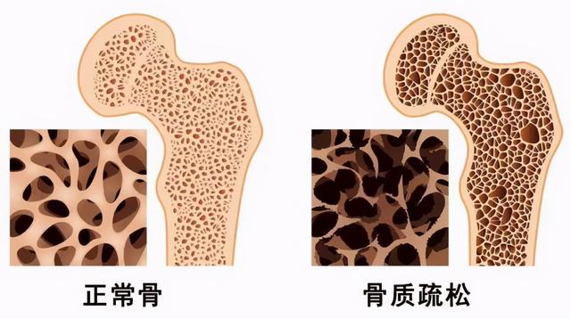 疏松|打个喷嚏，肋骨竟然折断！一查是因为这个病