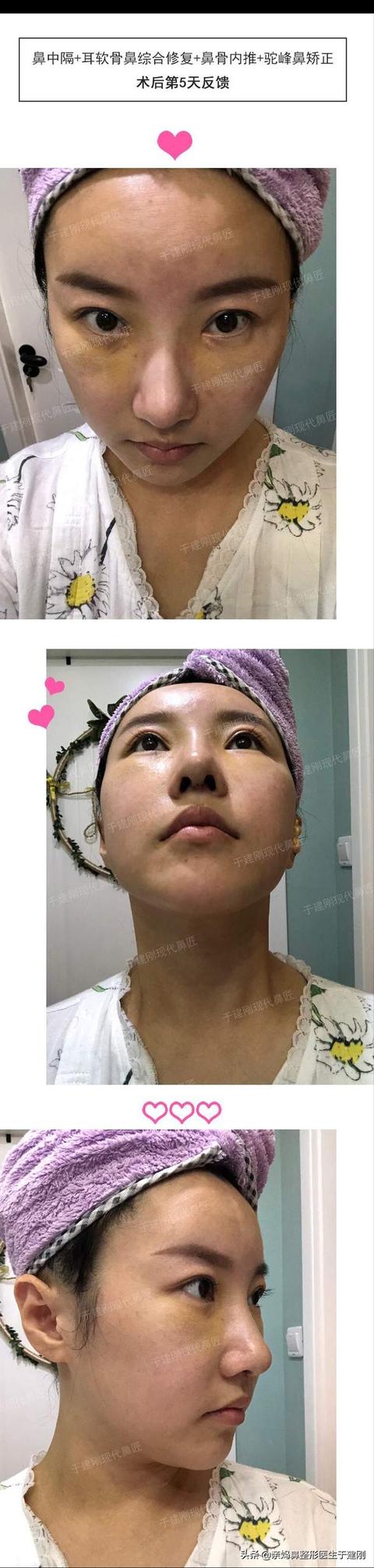 为什么宝妈都爱节假日做隆鼻？看完这篇，原来好处这么多